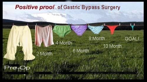 GastricBypass.jpg Gastric Bypass image by mekoe