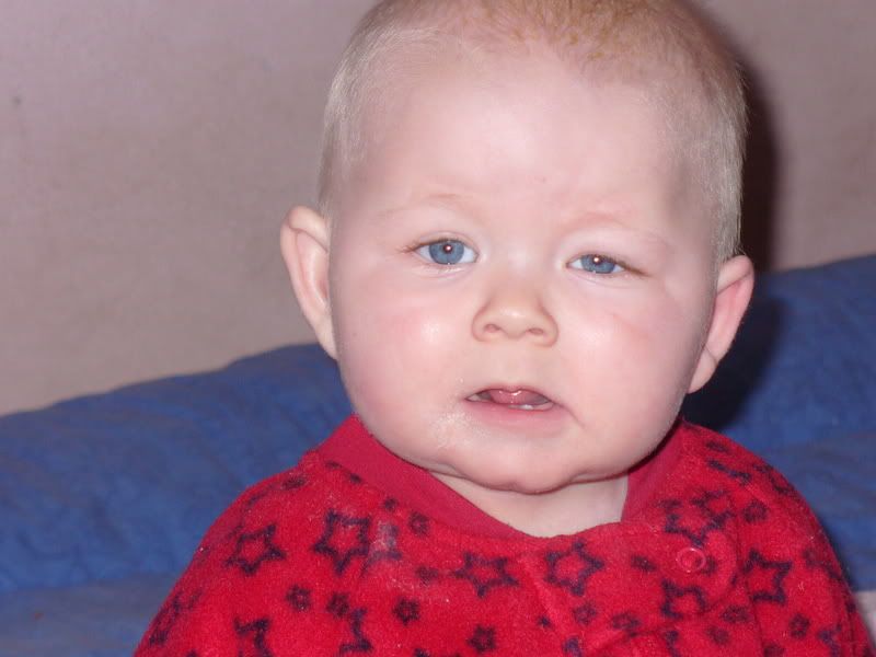 Toddler's eye swollen BabyGaga