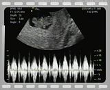 ultrasounds at 8 weeks. See more ultrasound at 8 weeks