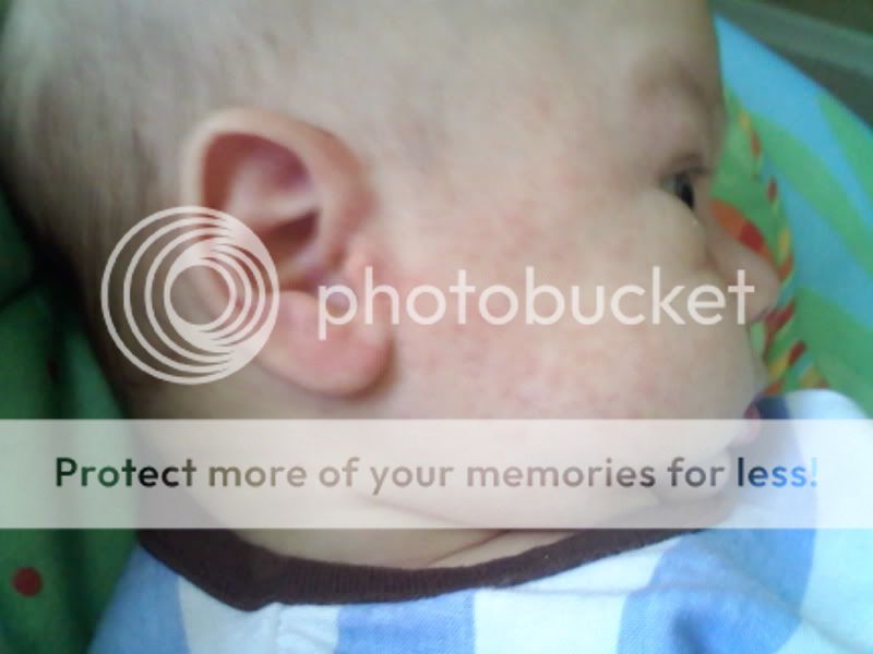 (x-posted) My 5 week old's rash - BabyCenter